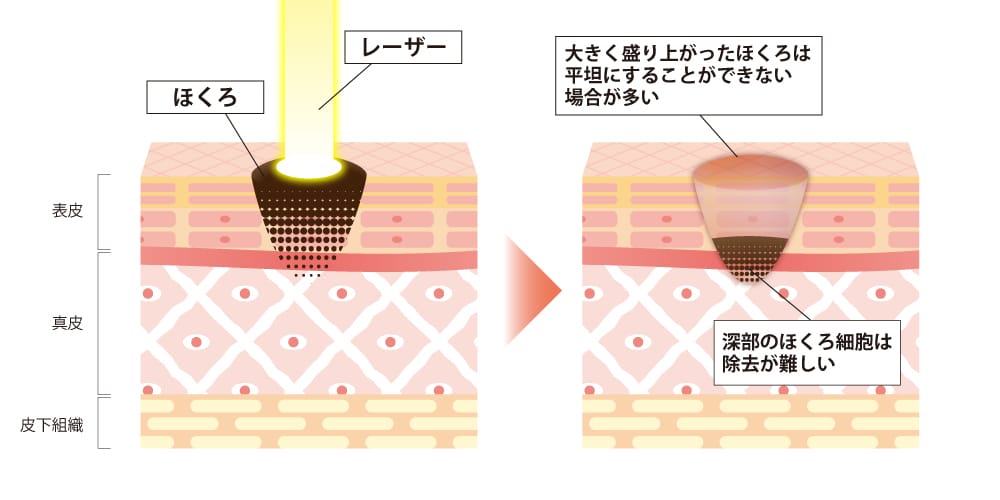 ホクロ取りレーザー治療イメージ図