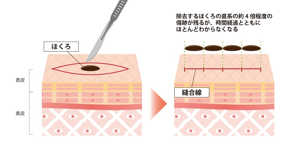 ホクロ取り治療切開法のイメージ図