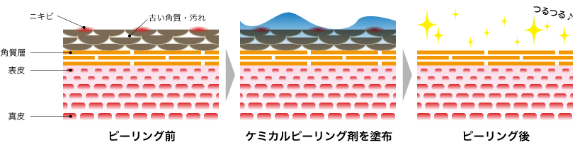 ケミカルピーリングの図解