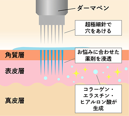 ダーマペンの図解