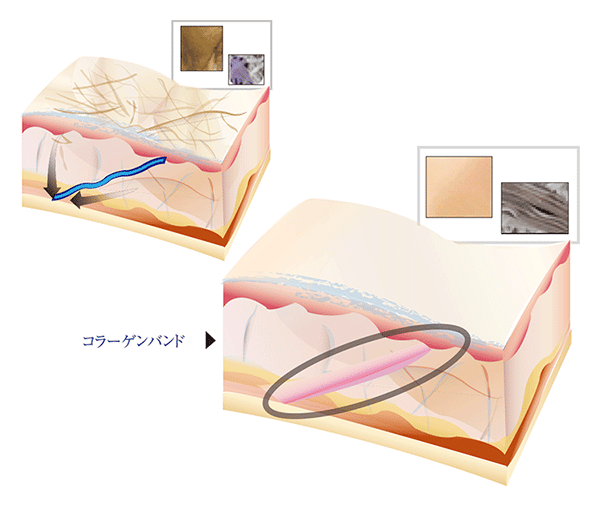 フレックスノーズ(クレオパトラノーズ)の特徴図解