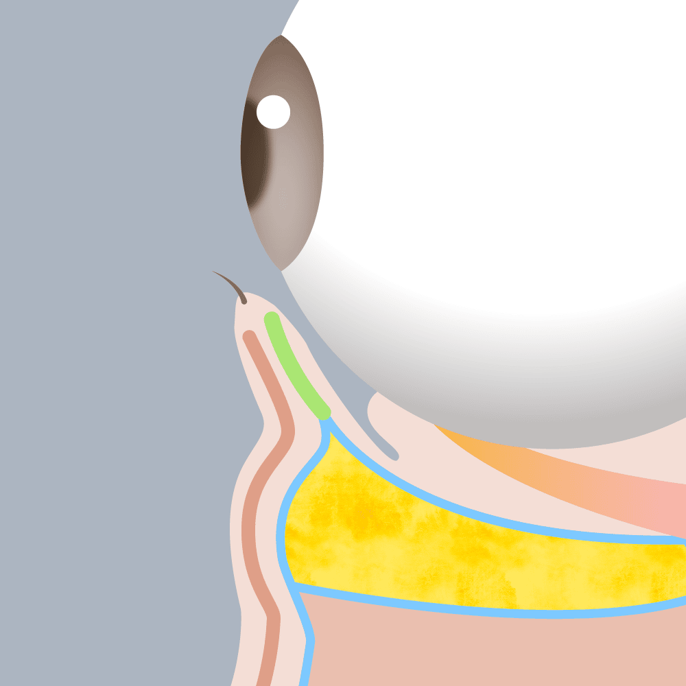 下眼瞼脱脂の図解