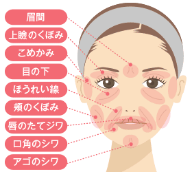 ヒアルロン酸注射で得られる効果図解