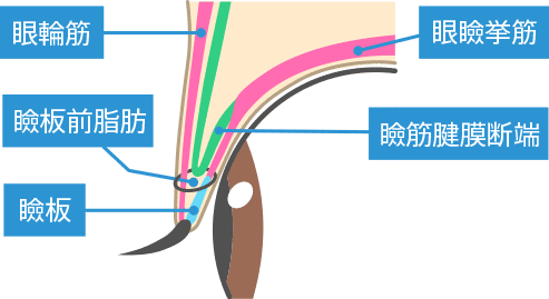 埋没法の図解