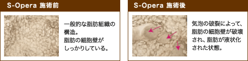 S-Opera施術前後の写真