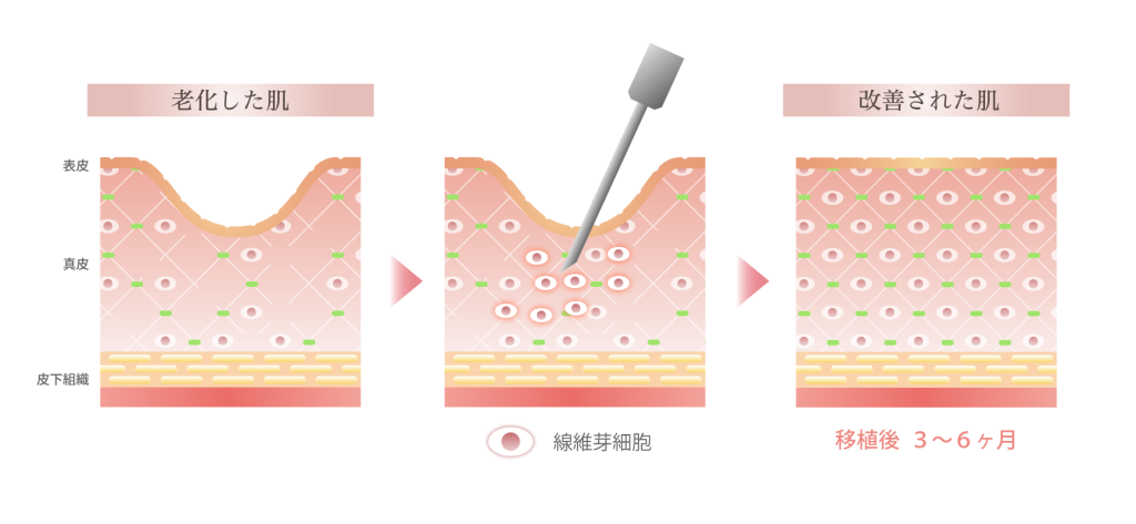 線維芽細胞の注入