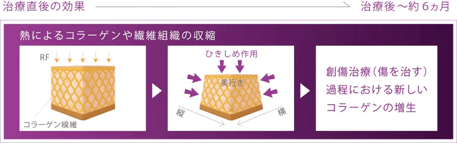 サーマクールFLX治療直後の効果図解