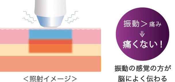 サーマクールFLX照射イメージ図解