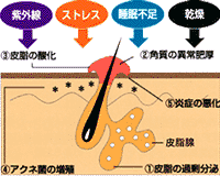 ニキビができる原因の図解