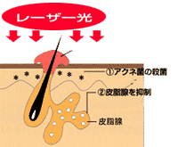 レーザー光の作用の図解